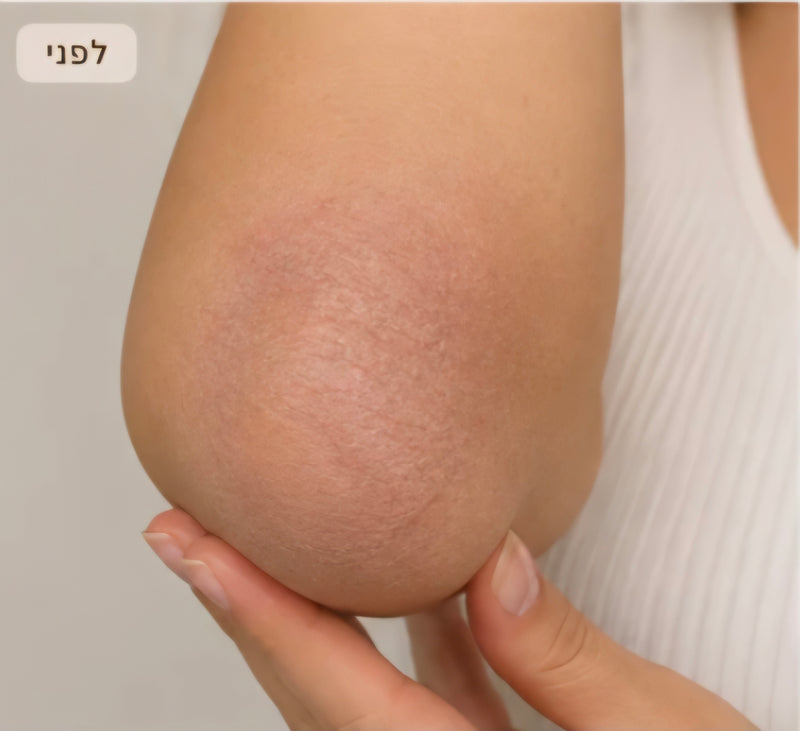 מצב העור לפני השימוש ב־Virelle